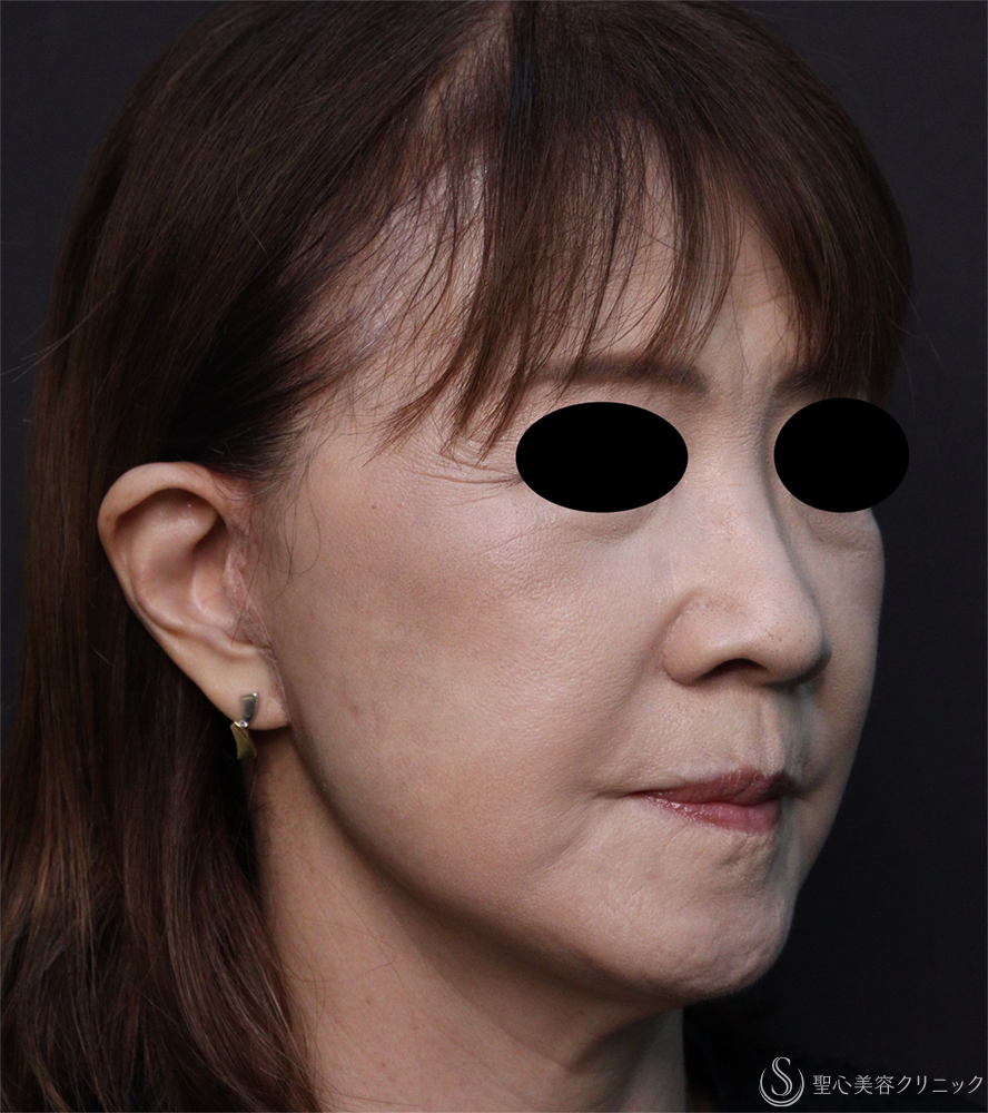 【60代女性・頬のたるみ】フェイスリフト（1ヶ月後） After 