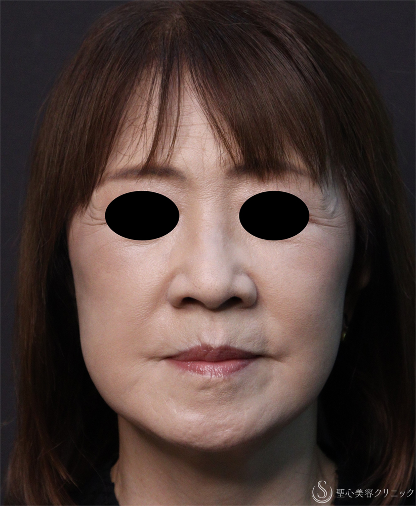 【60代女性・頬のたるみ】フェイスリフト（1ヶ月後） After 