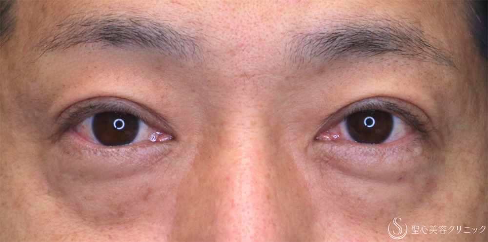 【40代男性・目の下のふくらみをスッキリ】下眼瞼切開術/下眼瞼除皺術/ハムラ法（1ヶ月後） Before 名古屋・クマ取り・アンチエイジング