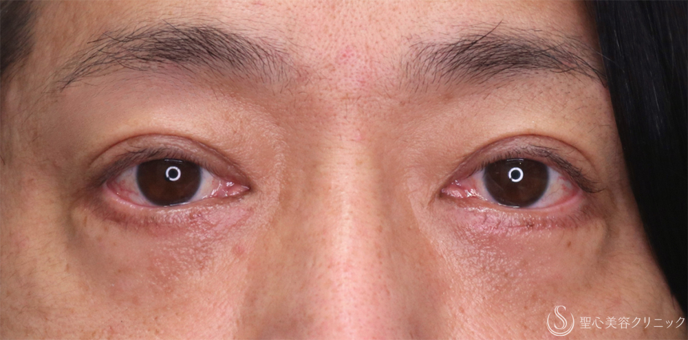 【40代男性・目の下のふくらみをスッキリ】下眼瞼切開術/下眼瞼除皺術/ハムラ法（1ヶ月後） After 名古屋・クマ取り・アンチエイジング
