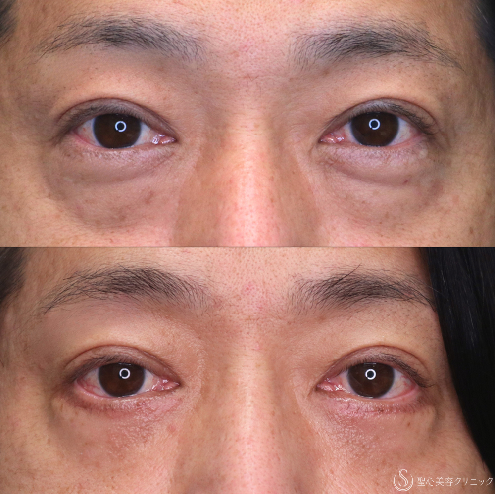 【40代男性・目の下のふくらみをスッキリ】下眼瞼切開術/下眼瞼除皺術/ハムラ法（1ヶ月後） After 名古屋・クマ取り・アンチエイジング