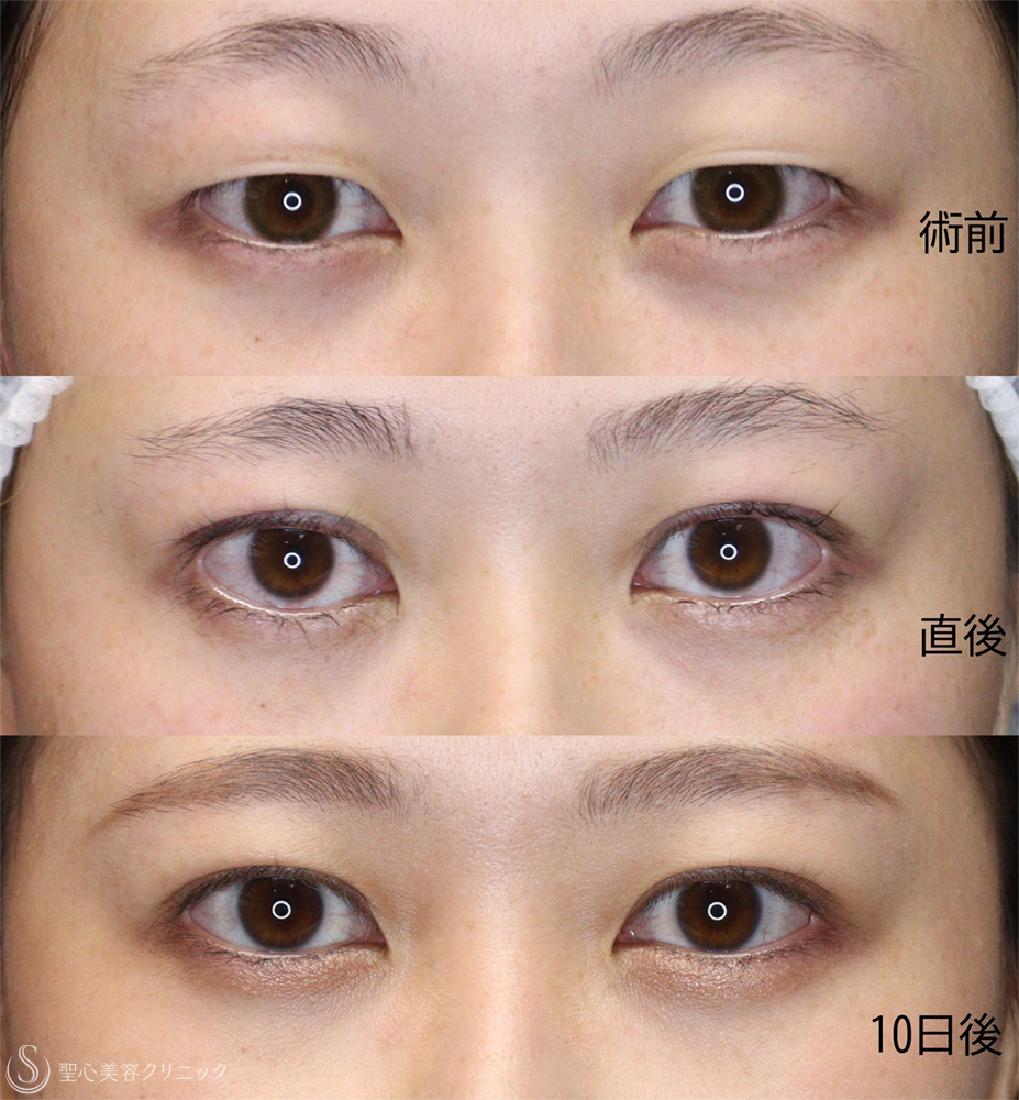【20代女性・目力のある自然な二重に】二重術（埋没法）：マイクロメソッド+α（10日後） After 