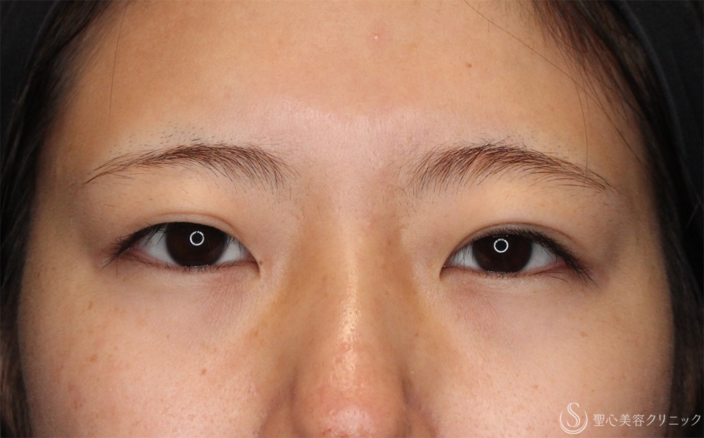 【20代女性・片目でもナチュラルに】 二重埋没法（右側ダブルノット法）（1ヶ月後） Before 
