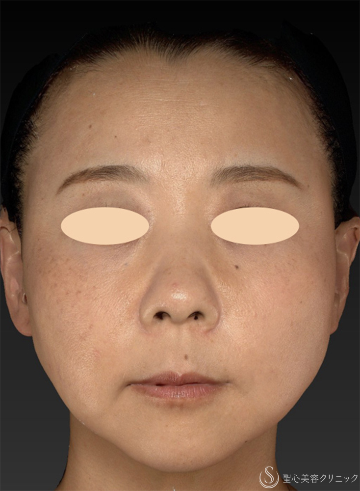 【40代女性・糸リフト長期経過3ヶ月後の3D解析】糸リフト（PDOスレッドリフト）（3ヶ月後） After 