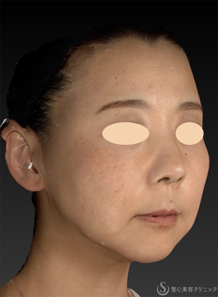 【40代女性・糸リフト長期経過3ヶ月後の3D解析】糸リフト（PDOスレッドリフト）（3ヶ月後） After 