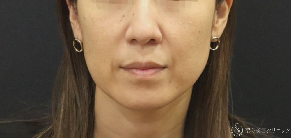 【40代女性・フェイスラインの改善】プレミアムPRP皮膚再生療法＋アンカーMAX（1ヶ月～1年後） Before 