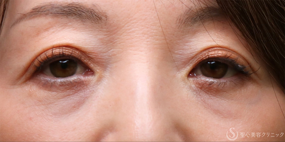 【40代女性・目の下のたるみを注射で解消】プレミアムPRP皮膚再生療法（目の下）（10ヶ月後） Before 