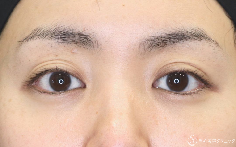 【30代女性・スッキリとした綺麗な二重】二重切開法（半年後） Before 