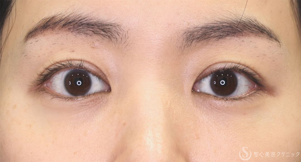 【30代女性・スッキリとした綺麗な二重】二重切開法（半年後） After 