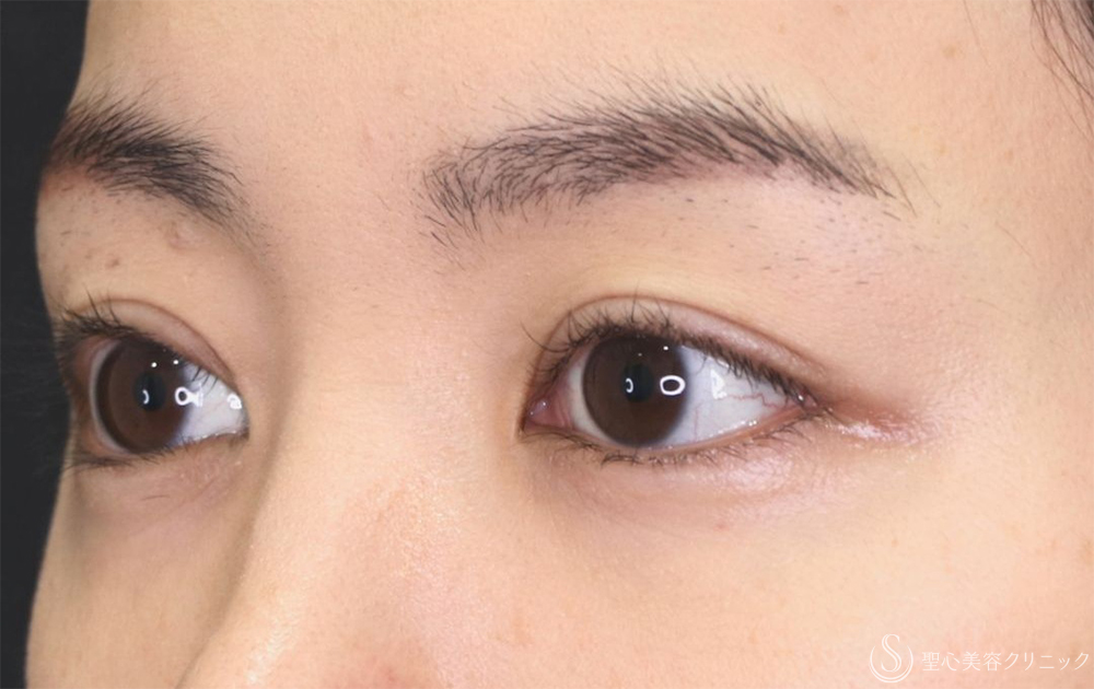 【30代女性・スッキリとした綺麗な二重】二重切開法（半年後） After 