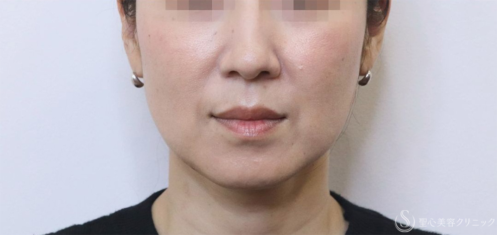 【40代女性・フェイスラインの改善】プレミアムPRP皮膚再生療法＋アンカーMAX（1ヶ月～1年後） After 