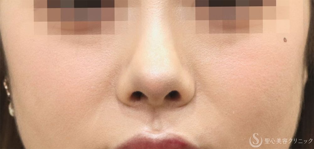 【20代女性・引き締まった鼻】鼻尖縮小＋耳介軟骨（1ヶ月半後） After 
