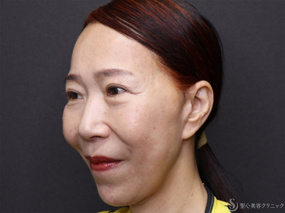 【60代女性・新しい糸リフトでフェイスラインスッキリ】フィオラスレッドエスト FL（4本）＋サポートスレッド（1ヶ月後） After 
