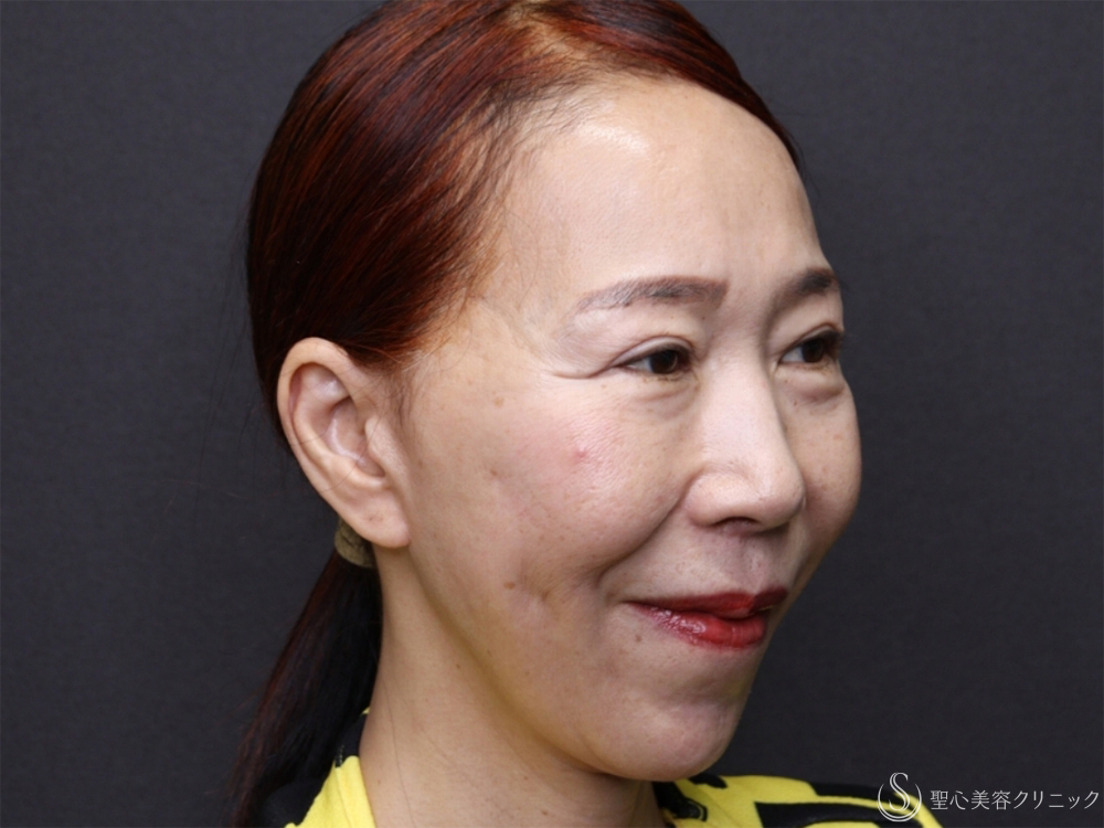 【60代女性・新しい糸リフトでフェイスラインスッキリ】フィオラスレッドエスト FL（4本）＋サポートスレッド（1ヶ月後） After 