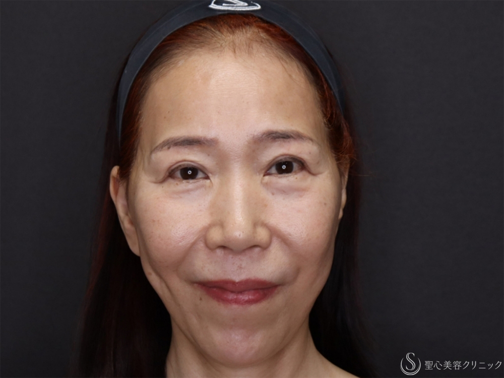 【60代女性・新しい糸リフトでフェイスラインスッキリ】フィオラスレッドエスト FL（4本）＋サポートスレッド（1ヶ月後） Before 