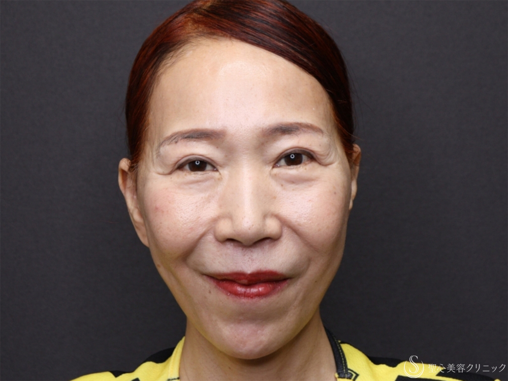 【60代女性・新しい糸リフトでフェイスラインスッキリ】フィオラスレッドエスト FL（4本）＋サポートスレッド（1ヶ月後） After 