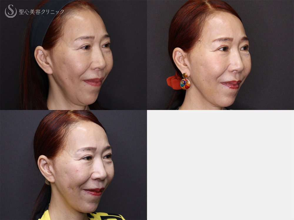 【60代女性・新しい糸リフトでフェイスラインスッキリ】フィオラスレッドエスト FL（4本）＋サポートスレッド（1ヶ月後） After 