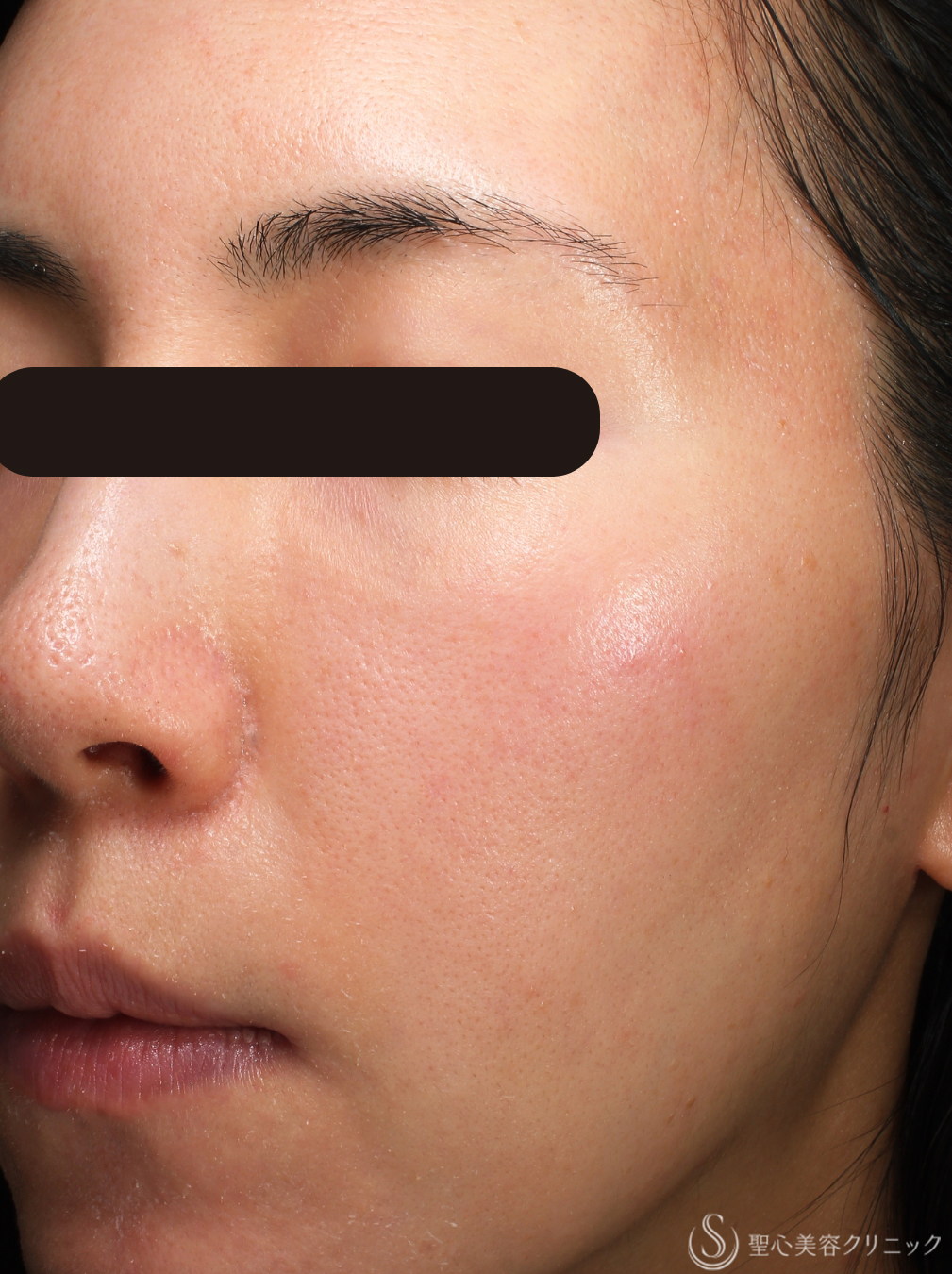 【30代女性・より白く滑らかな肌に】プルリアルデンシファイ（毛穴）（4回後） Before 