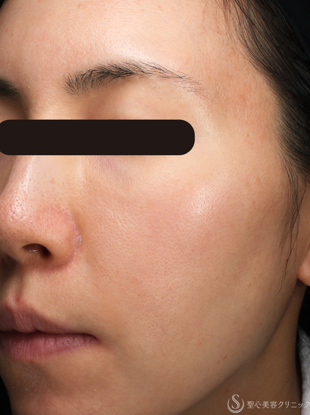 【30代女性・より白く滑らかな肌に】プルリアルデンシファイ（毛穴）（4回後） After 