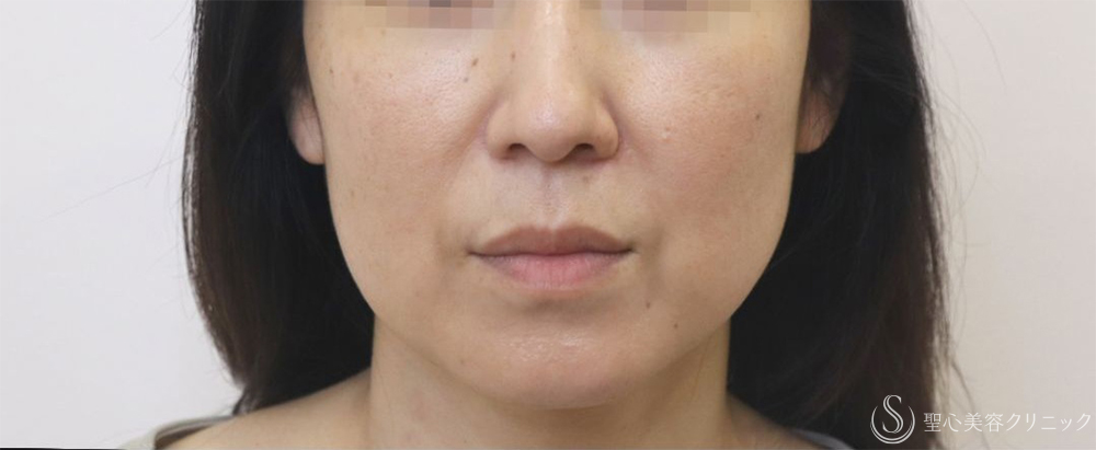 【40代女性・フェイスラインの改善】プレミアムPRP皮膚再生療法＋アンカーMAX（1ヶ月～1年後） After 