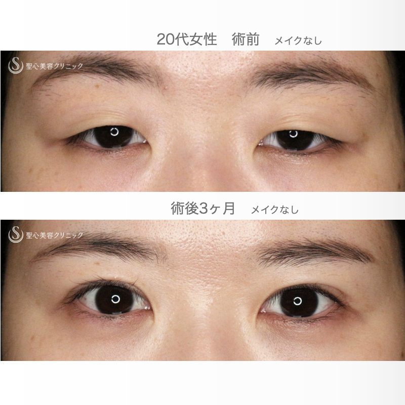 【20代女性・人の印象は目元で変わる】二重全切開+α法「Ver.5.5」（術直後〜3ヶ月後） After 