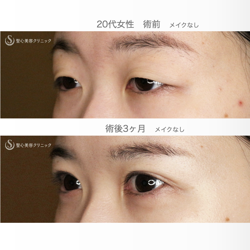 【20代女性・人の印象は目元で変わる】二重全切開+α法「Ver.5.5」（術直後〜3ヶ月後） After 