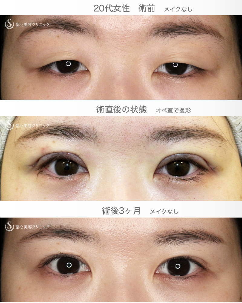 【20代女性・人の印象は目元で変わる】二重全切開+α法「Ver.5.5」（術直後〜3ヶ月後） After 