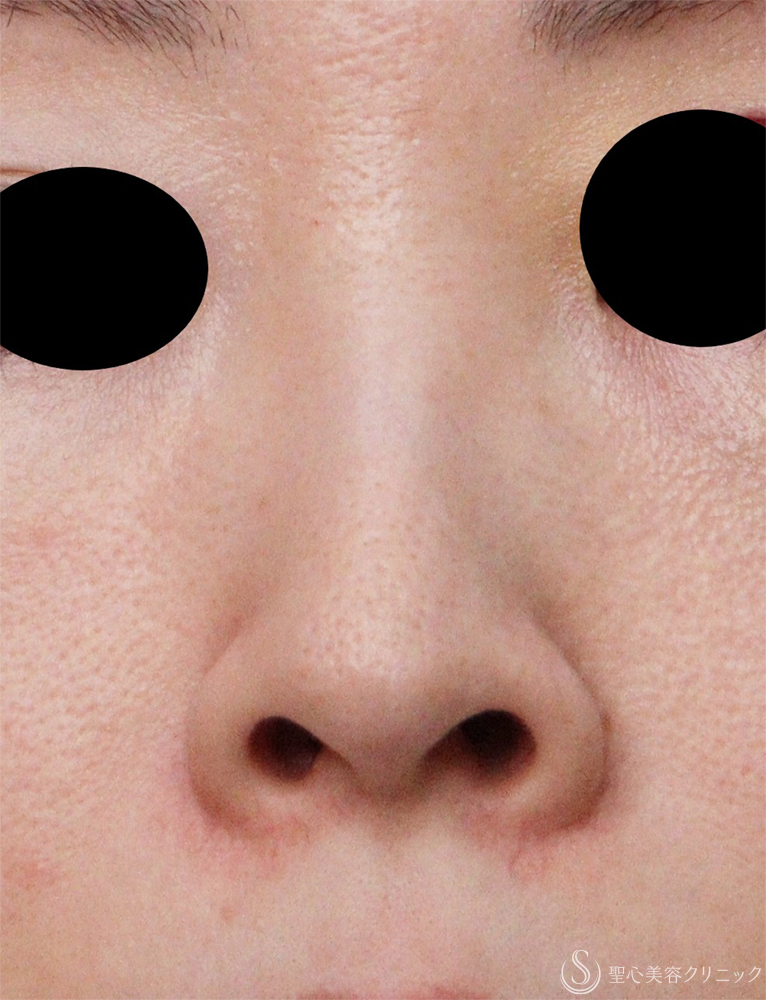 【30代女性・小さな鼻へ】小鼻縮小（1ヶ月後） Before 