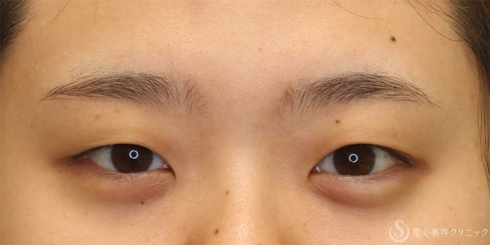 【20代女性・二重で目をパッチリ】二重術（切開法）＋眼窩脂肪除去（1ヶ月後） Before 