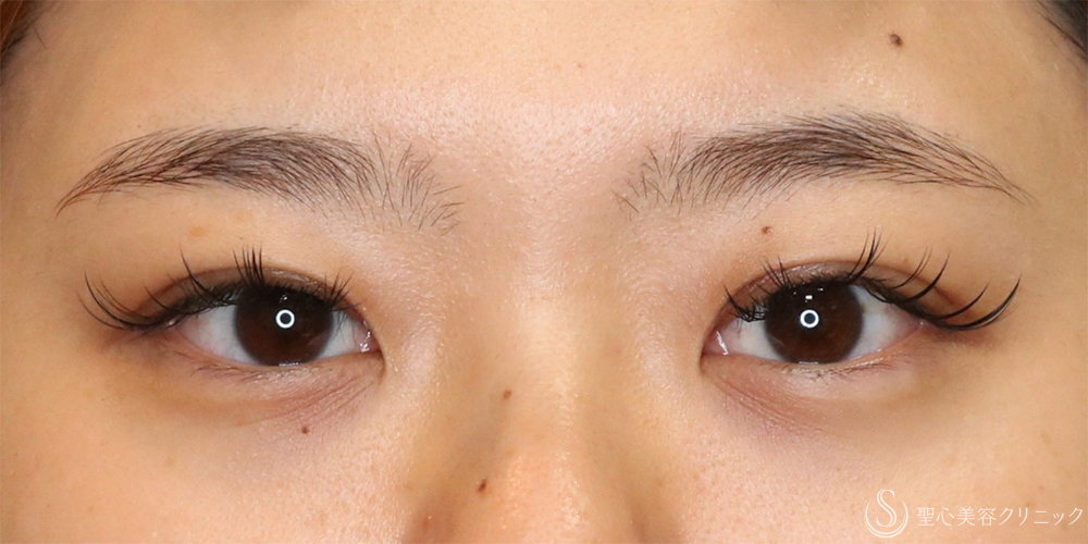 【20代女性・二重で目をパッチリ】二重術（切開法）＋眼窩脂肪除去（1ヶ月後） After 