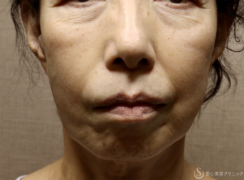 【60代女性・顔の弛み】ディーププレーンフェイスリフト（術後1週間） Before 