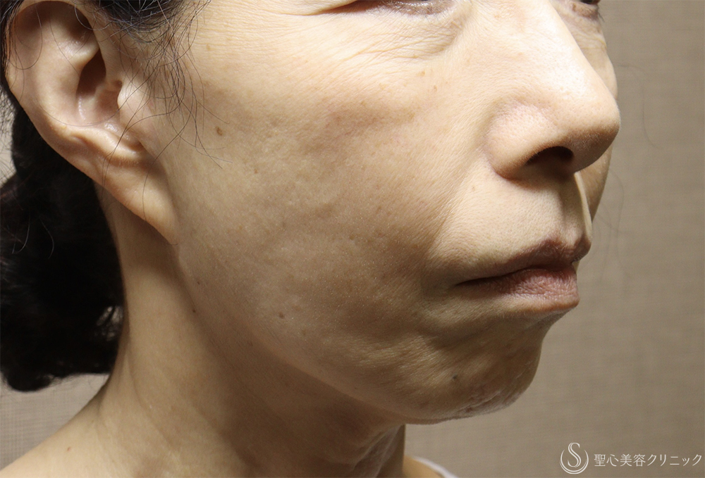 【60代女性・顔の弛み】ディーププレーンフェイスリフト（術後1週間） Before 