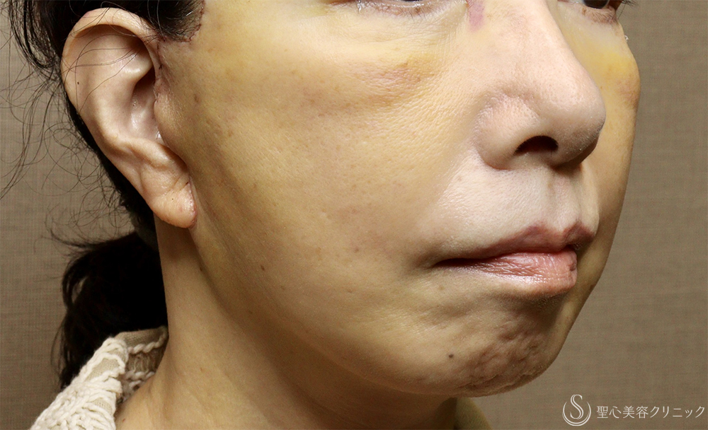 【60代女性・顔の弛み】ディーププレーンフェイスリフト（術後1週間） After 