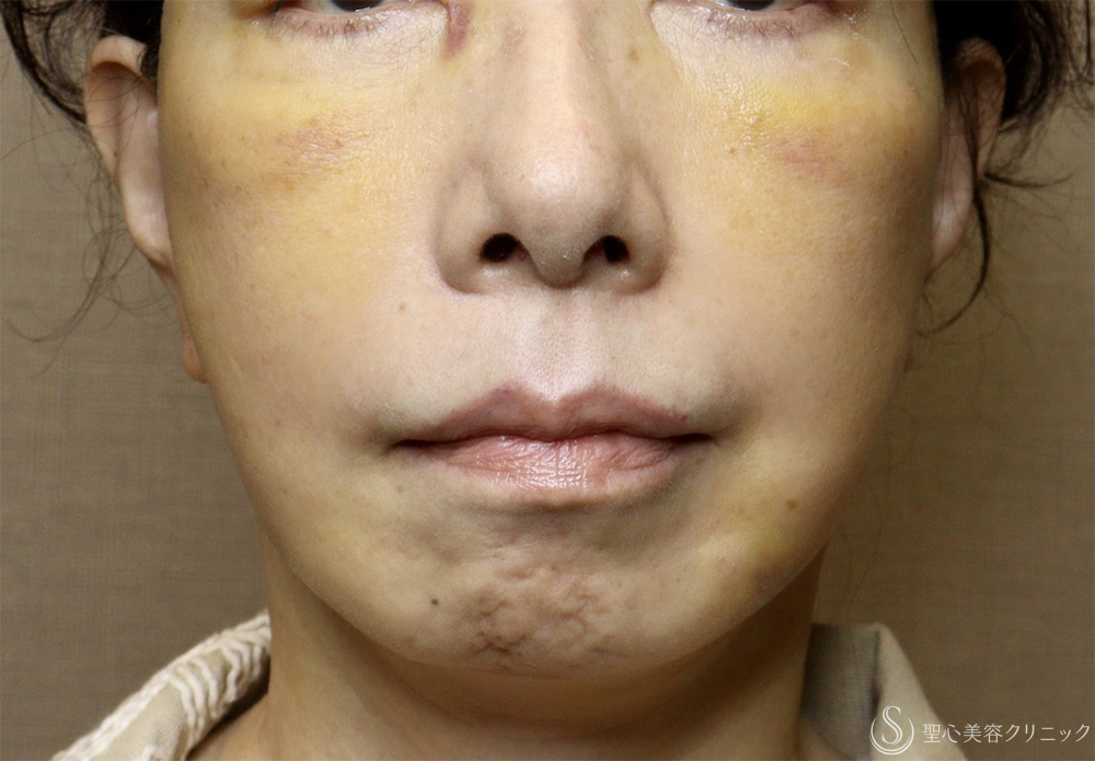 【60代女性・顔の弛み】ディーププレーンフェイスリフト（術後1週間） After 