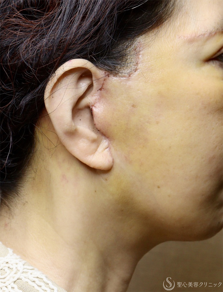 【60代女性・顔の弛み】ディーププレーンフェイスリフト（術後1週間） After 