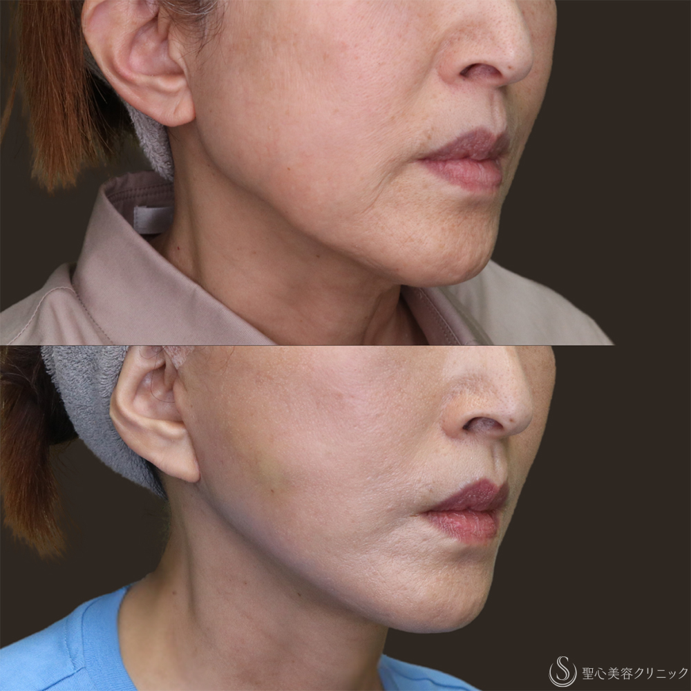 【60代女性・フェイスラインをスッキリ】フェイスリフト＋脂肪吸引（頬・顎下）＋リガメント処理（1ヶ月後） After 名古屋・アンチエイジング・切開リフト