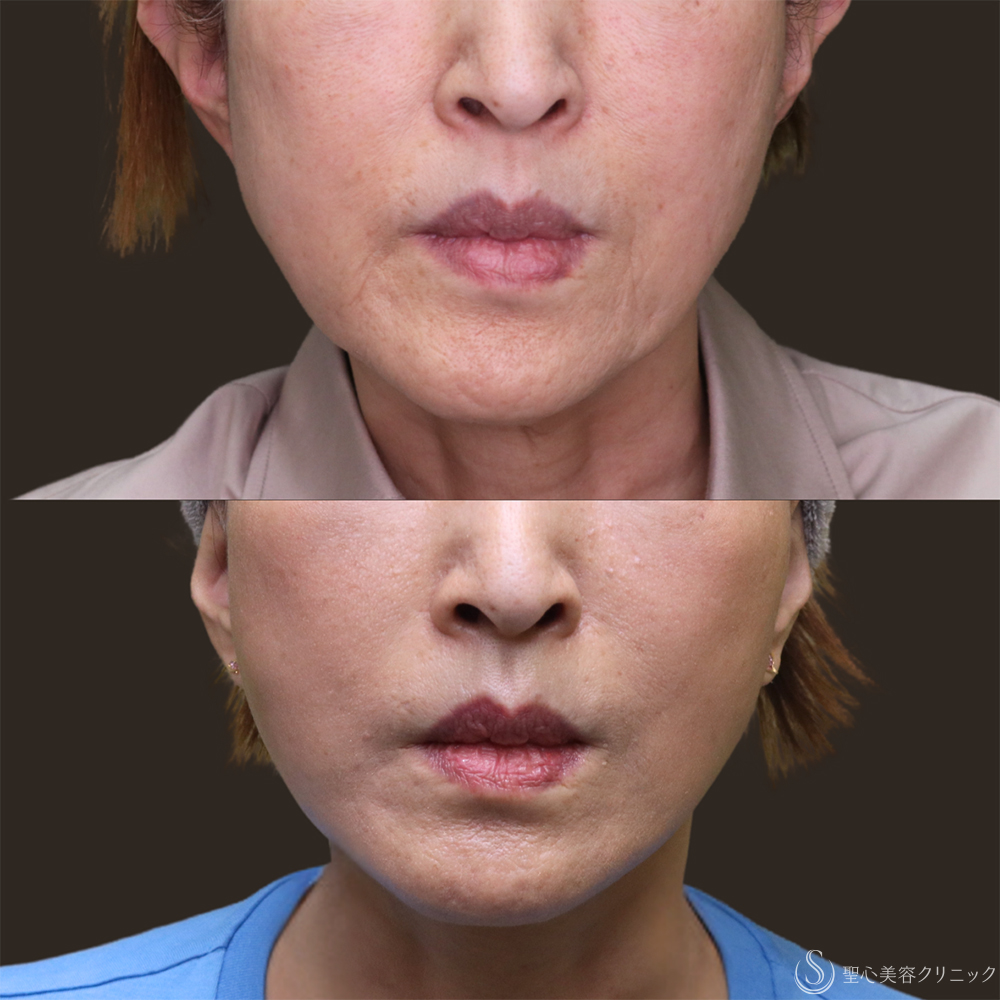 【60代女性・フェイスラインをスッキリ】フェイスリフト＋脂肪吸引（頬・顎下）＋リガメント処理（1ヶ月後） After 名古屋・アンチエイジング・切開リフト