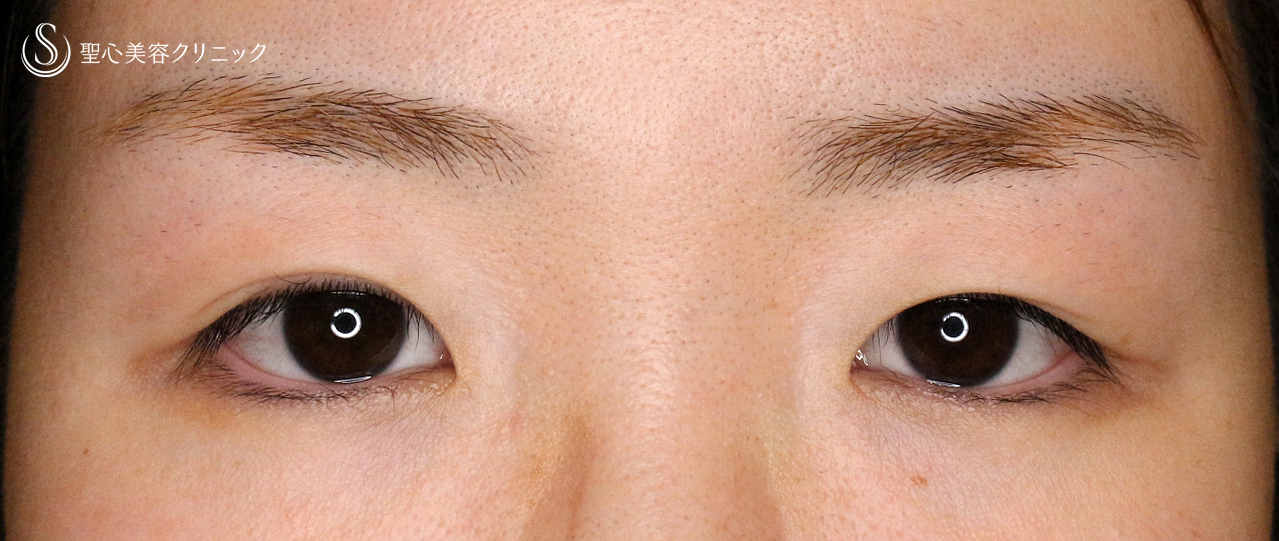 【30代女性・二重埋没法で自然な末広型】マイクロメソッド+α PVDF 3点留め（2ヶ月後） Before 