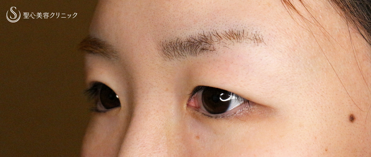 【30代女性・二重埋没法で自然な末広型】マイクロメソッド+α PVDF 3点留め（2ヶ月後） Before 