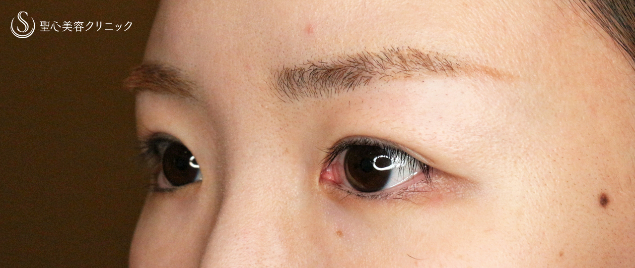 【30代女性・二重埋没法で自然な末広型】マイクロメソッド+α PVDF 3点留め（2ヶ月後） After 