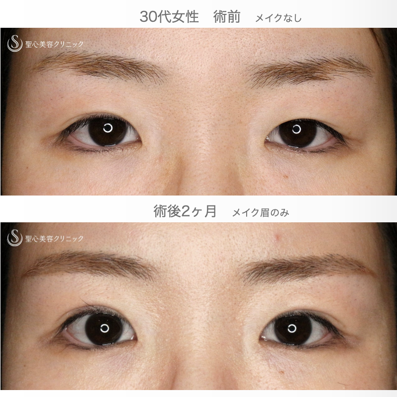 【30代女性・二重埋没法で自然な末広型】マイクロメソッド+α PVDF 3点留め（2ヶ月後） After 