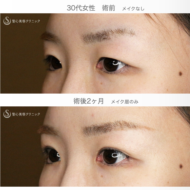 【30代女性・二重埋没法で自然な末広型】マイクロメソッド+α PVDF 3点留め（2ヶ月後） After 