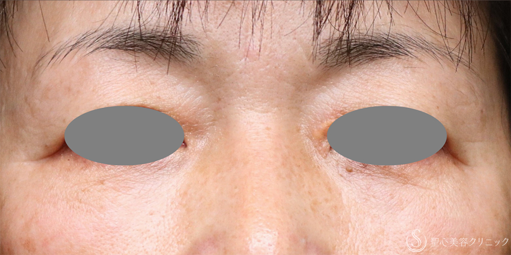 【50代女性・長期的な効果実感】プレミアムPRP皮膚再生療法（目の下）（3年6ヶ月後） After 