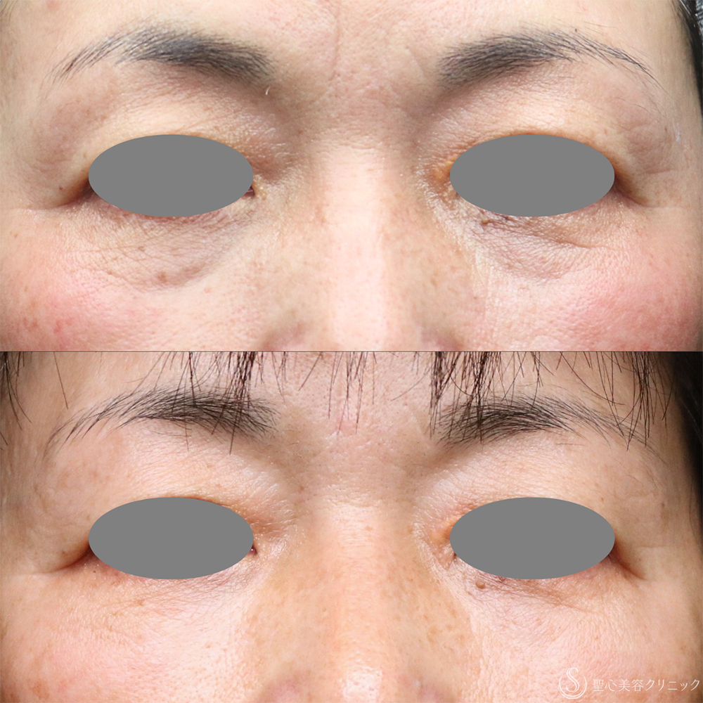 【50代女性・長期的な効果実感】プレミアムPRP皮膚再生療法（目の下）（3年6ヶ月後） After 名古屋・クマ治療・アンチエイジング・クマ取り