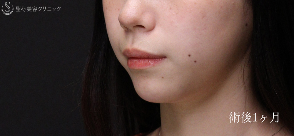【20代女性・Eラインを整えることで輪郭を激変】あごプロテーゼ（術後1ヶ月～3ヶ月） After 