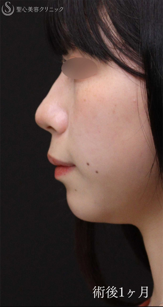 【20代女性・Eラインを整えることで輪郭を激変】あごプロテーゼ（術後1ヶ月～3ヶ月） After 