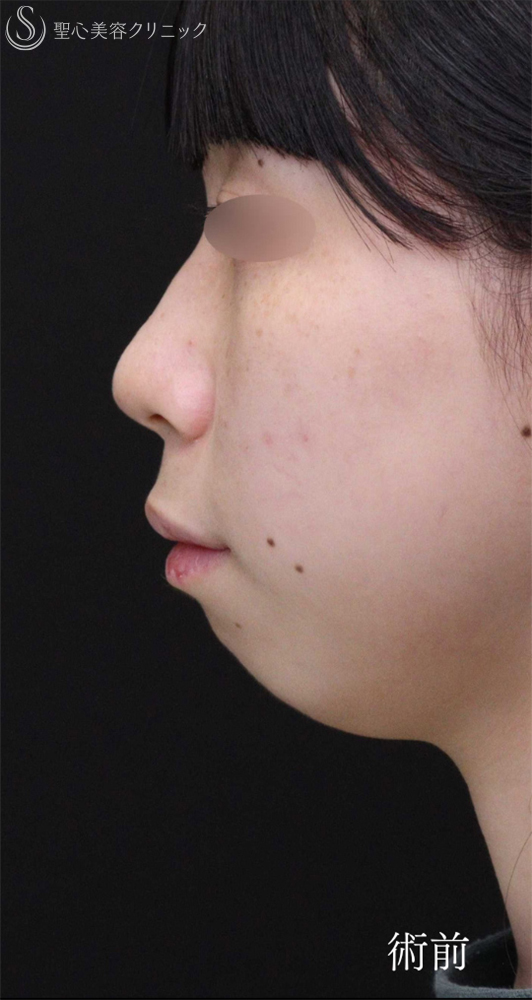 【20代女性・Eラインを整えることで輪郭を激変】あごプロテーゼ（術後1ヶ月～3ヶ月） Before 