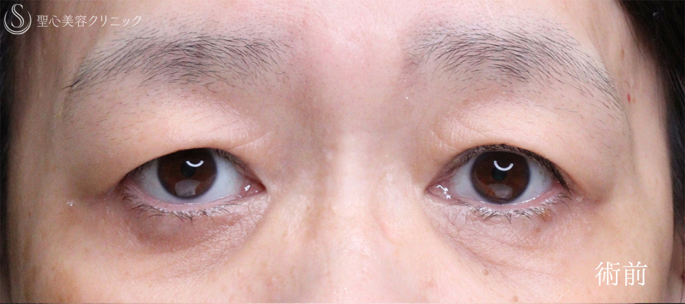 【50代女性・自然な目の開きを実現】眉下リフト（術後1ヶ月） Before 