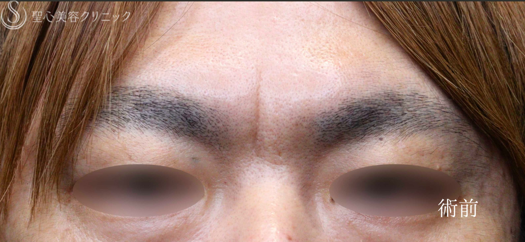 【40代男性・刻まれた眉間の皺を改善】プレミアムPRP皮膚再生療法（術後4ヶ月） Before 