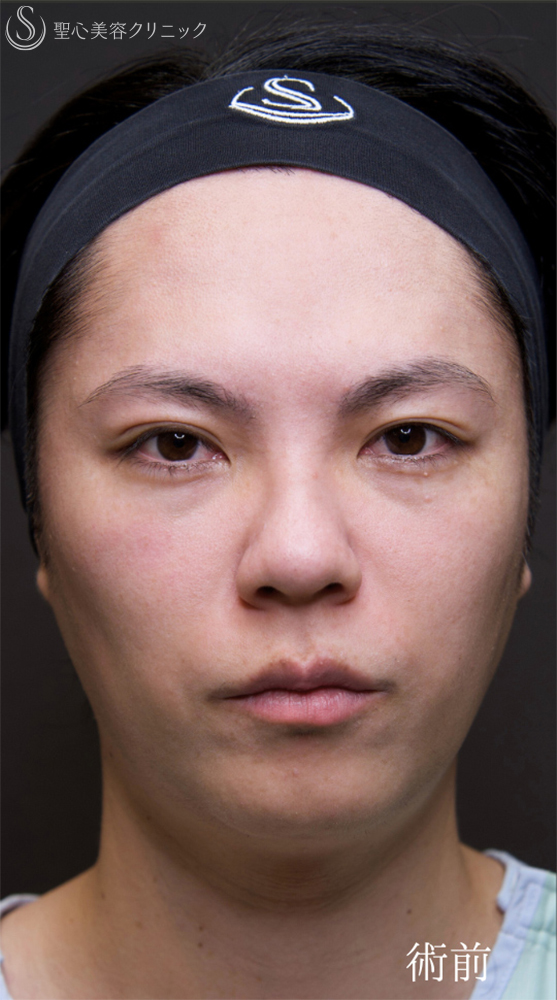 【30代男性・自然なクマの改善を】下眼瞼切開術/下眼瞼除皺術/ハムラ法（術後1ヶ月） Before 